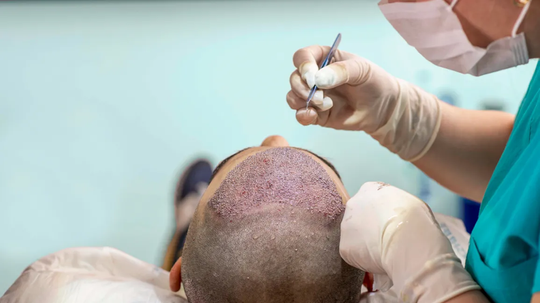 What You Need to Know Before Getting a Hair Transplant: A Comprehensive Guide