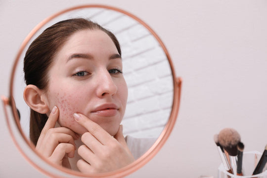 Sudden Acne Breakouts in Women: What’s Really Causing It & What Actually Works