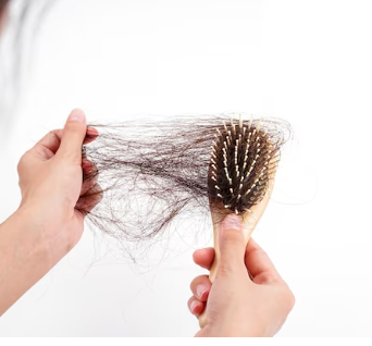 “Excessive hair fall seen in hairbrush indicating hair thinning and hair loss problem”